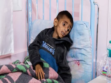 തെക്കൻ ഗാസ മുനമ്പിലെ ഖാൻ യൂനിസിലെ നാസർ ആശുപത്രിയിൽ ചികിത്സയിൽ കഴിയുന്ന 5 വയസ്സുള്ള പലസ്ഥീൻ ബാലൻ ഒസാമ അൽ-റെഖെപ് (ചിത്രം: REUTERS)