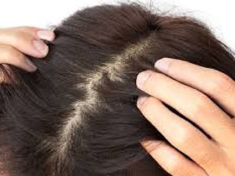 side effects of hair color, negative effects of hair color, negative impact of hair color, why shouldn't you use hair color, Side effects of hair dye, Hair coloring side effects, Dangers of frequent hair coloring, Hair dye damage, Hair dye and hair fall, Hair dye allergic reaction, Scalp irritation from hair dye, Natural hair dye alternatives, How to protect hair from hair dye damage Chemical hair dye risks, Hair coloring side effects ,Hair fall from dye, हेयर फॉल, Scalp irritation, Harmful Effects Of Hair Dyes, Hair Color, Hair Dyes, Hair Fall, Scalp Irritation, health news, news18 , news18 Malayalam ,ഹെയർ കളർ , തലമുടിയിൽ കളറുകൾ , മാറി മാറി പരീക്ഷിക്കുവർ, അലർജി , കാൻസർ , മുടി കളർ, സ്റ്റൈലിഷ് ,കെമിക്കല്‍ ട്രീറ്റ്‌മെന്‍റ്, ഹെയർ ഡൈകൾ, ഹെൽത്ത് ന്യൂസ് , മുടി , ദൂഷ്യ വശങ്ങൾ , 